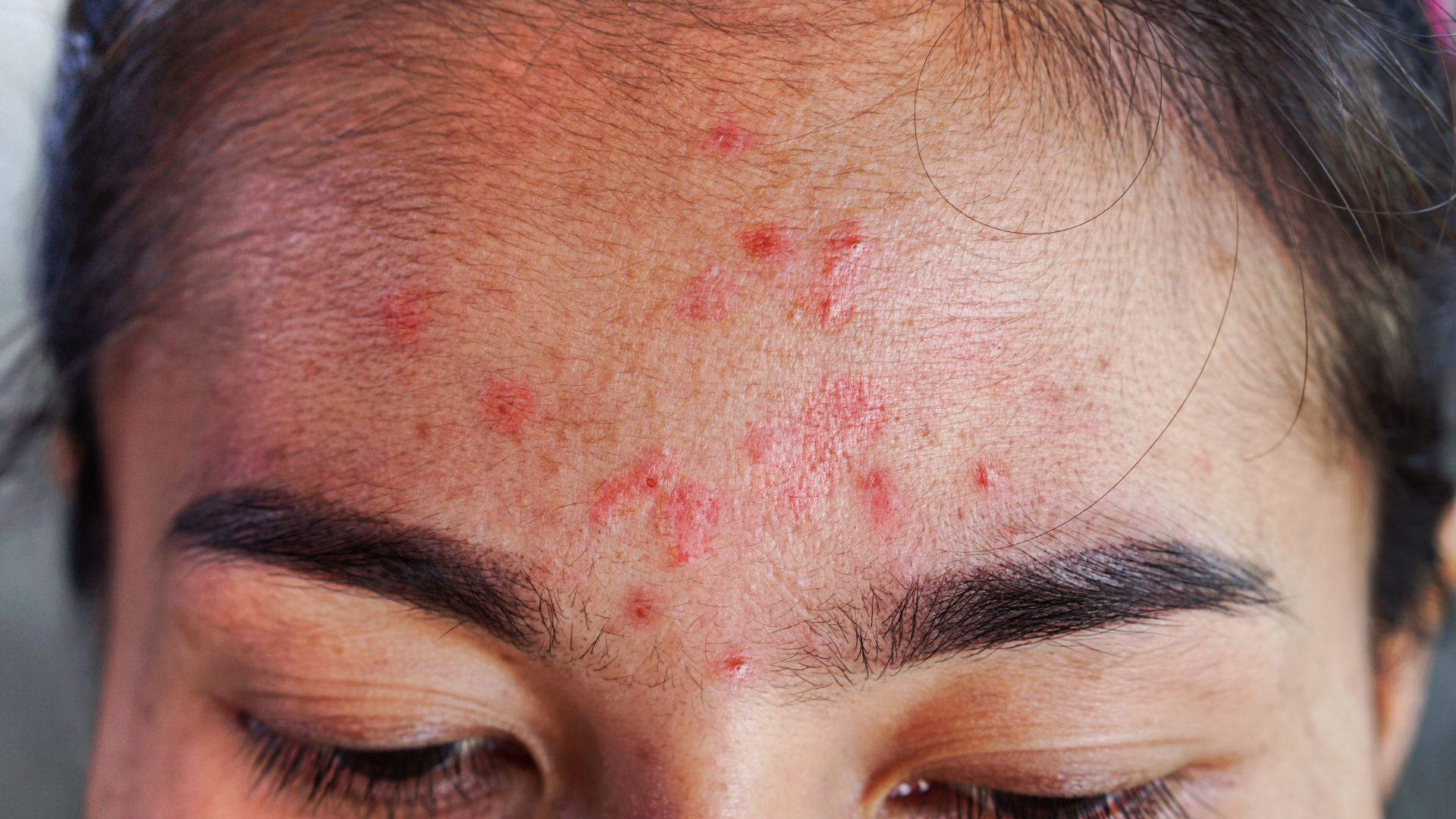 Acne Explained: Debunking Common Myths and Misconceptions