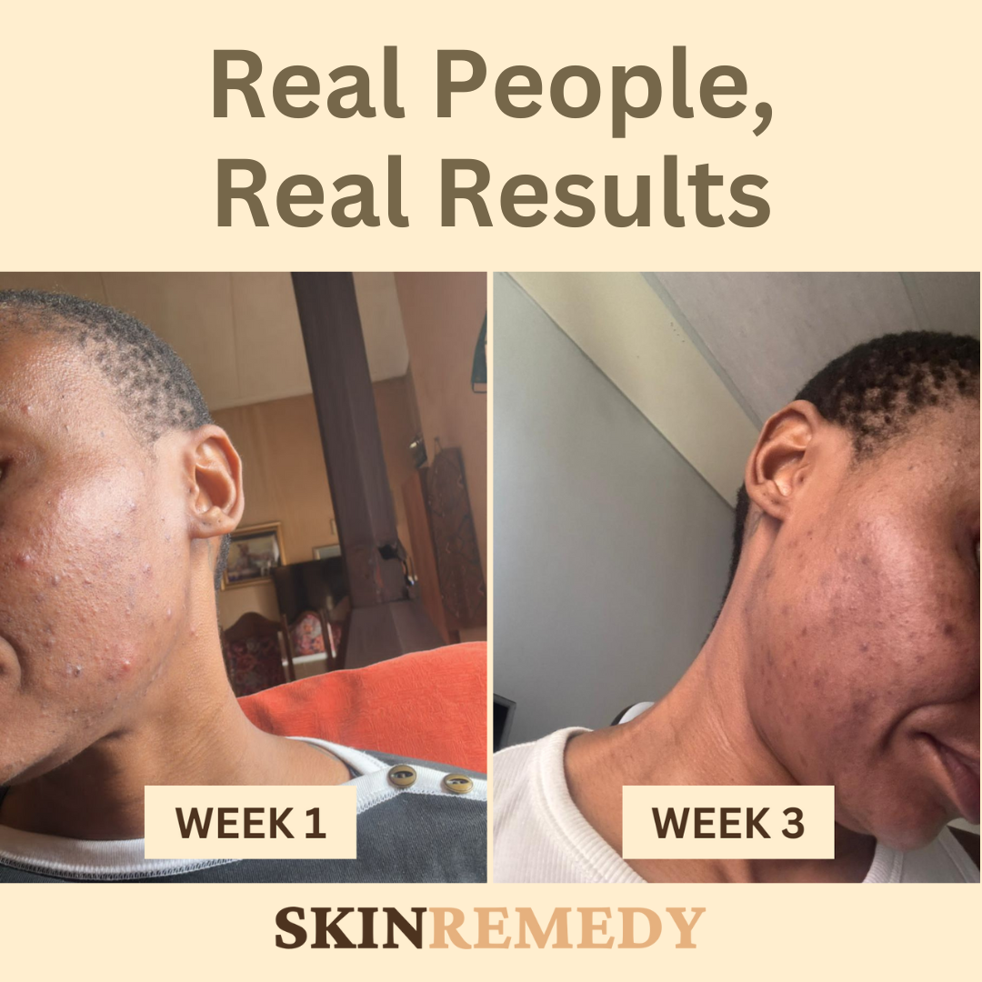 Skin Remedy -Before/After
