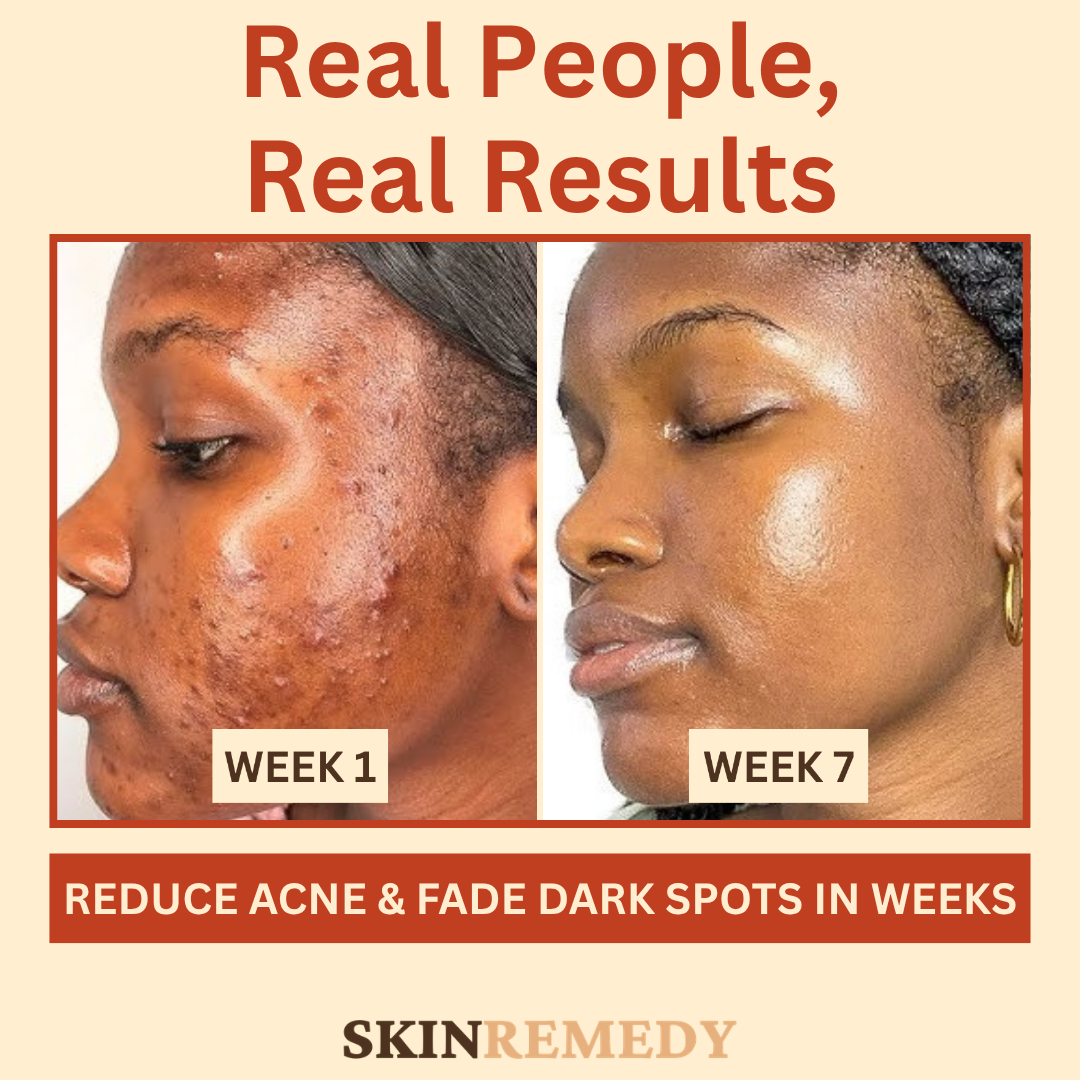 Acne and Dark Mark Control Collection