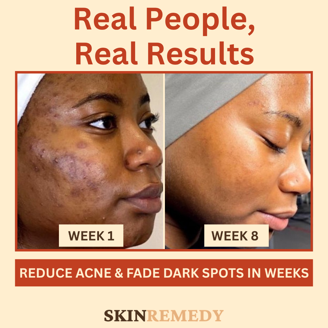 Acne and Dark Mark Control Collection