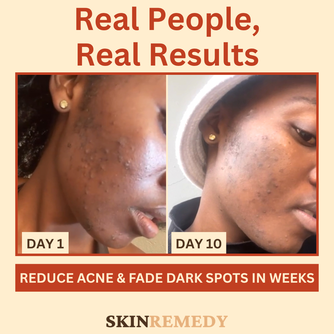 Acne and Dark Mark Control Collection